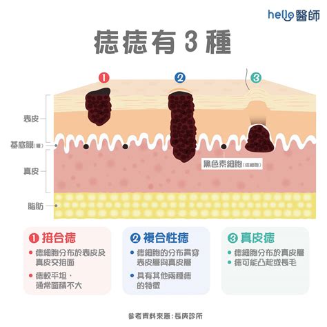 臉上的痣長毛|為什麼臉上的痣越來越多？皮膚科醫師解析長痣原因、。